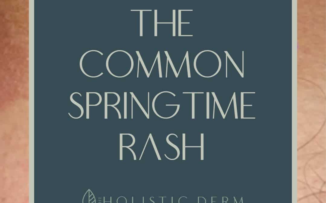 The Common Spring Rash