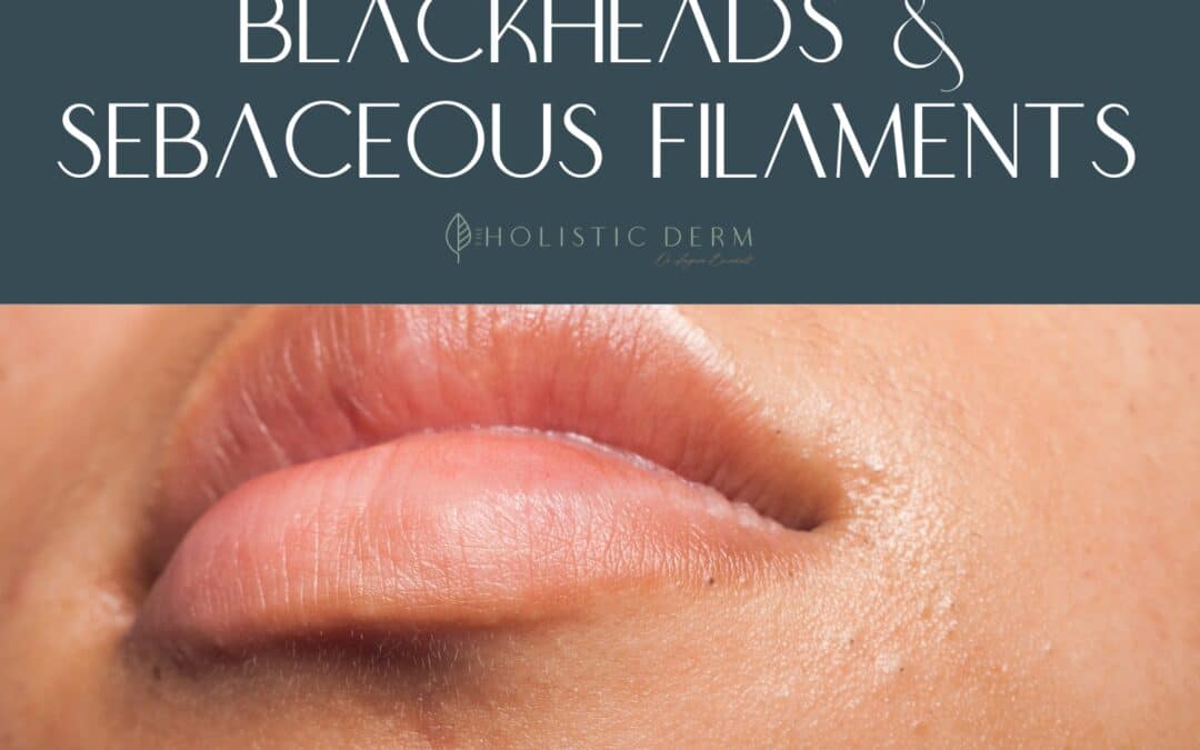 Stop Pinching and Popping Your Blackheads and Sebaceous Filaments: A Dermatologist’s Warning